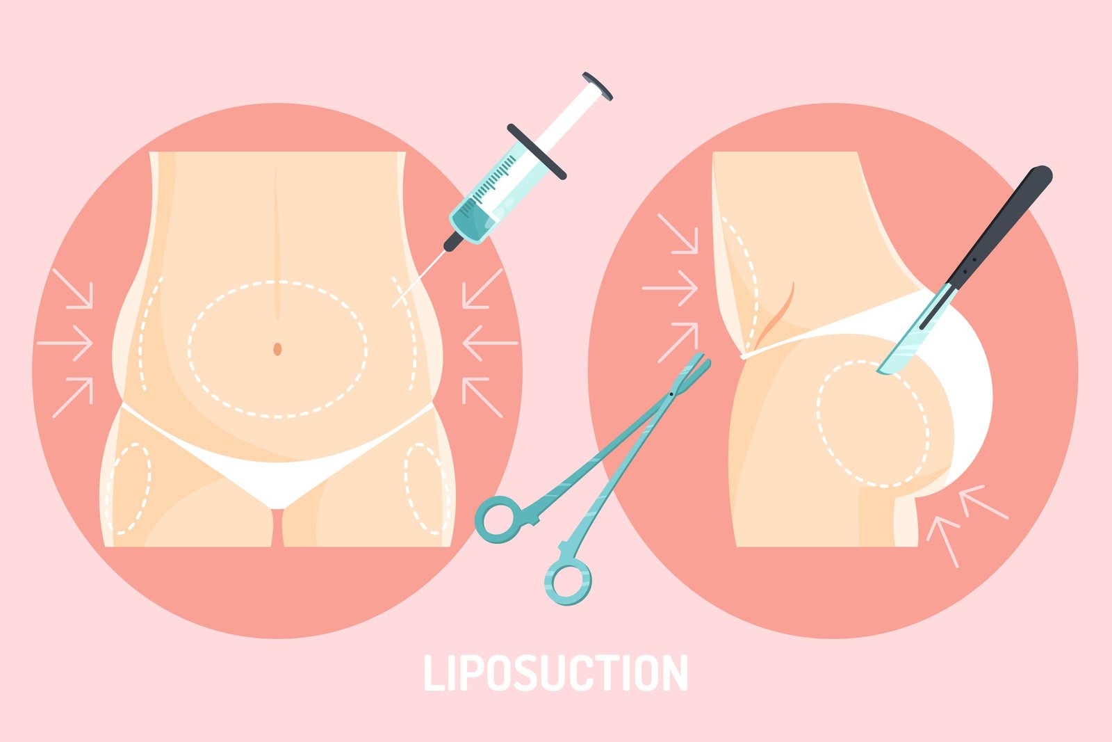 vaser-liposuction-surgery in-delhi